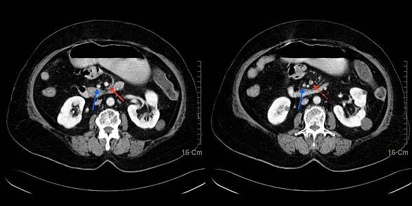 01 SMA embolism.jpg