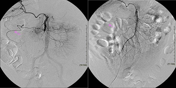 05 SMA embolism.jpg