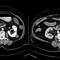 07 SMA embolism.jpg