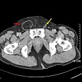 01 inguinal hernia.jpg