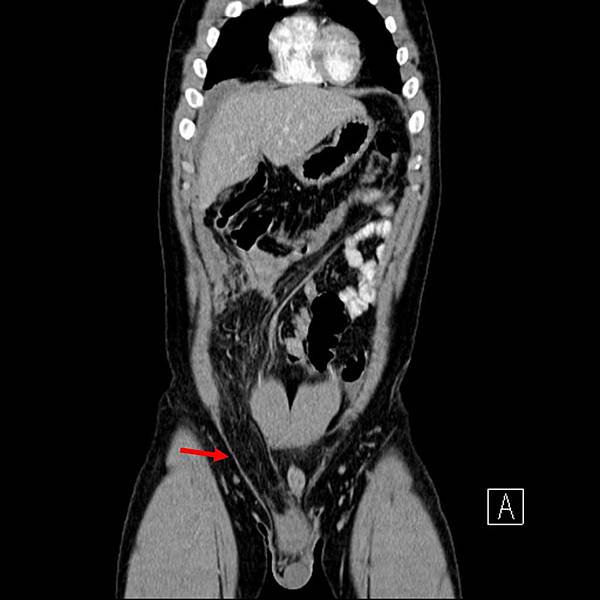 02 Inguinal hernia.jpg