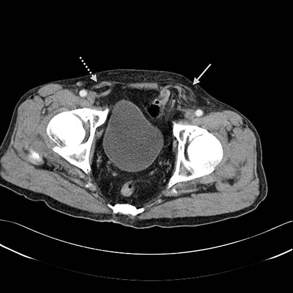 04 Inguinal hernia.jpg