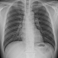 Chest X ray.jpg