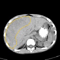 07 subcapsular hematoma 02.jpg