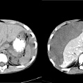 08 subcapsular hematoma 03.jpg