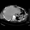 09 hemoperitoneum.jpg