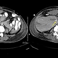 10 hemoperitoneum, active bleeding.jpg