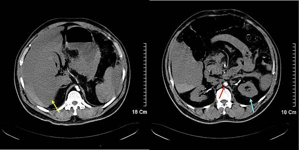 12 hemoperitoneum, abdominal compartment syndrome.jpg