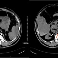 12 hemoperitoneum, abdominal compartment syndrome.jpg