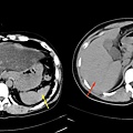 03 脂肪肝 fatty liver.jpg