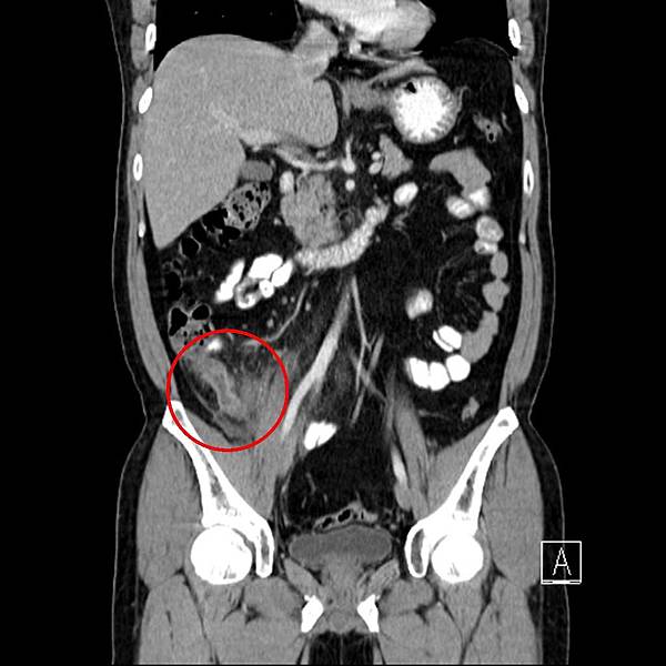 02 闌尾炎 appendicitis.jpg