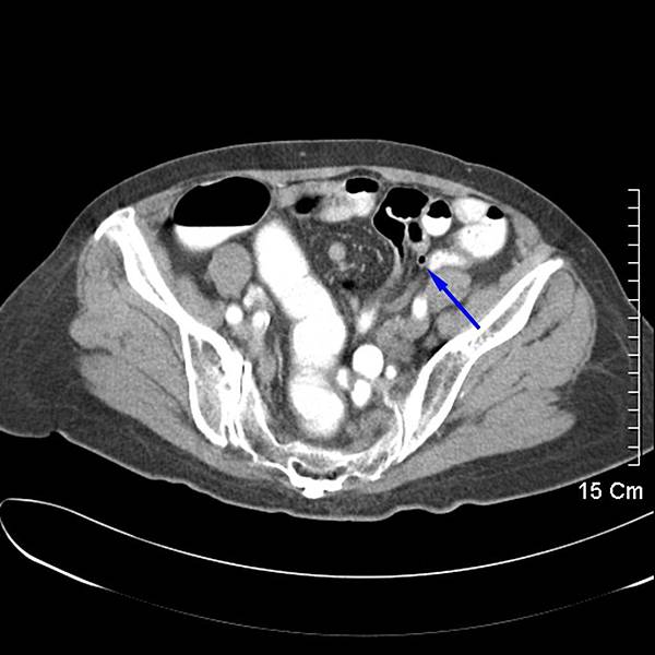 12 闌尾 left appendix.jpg