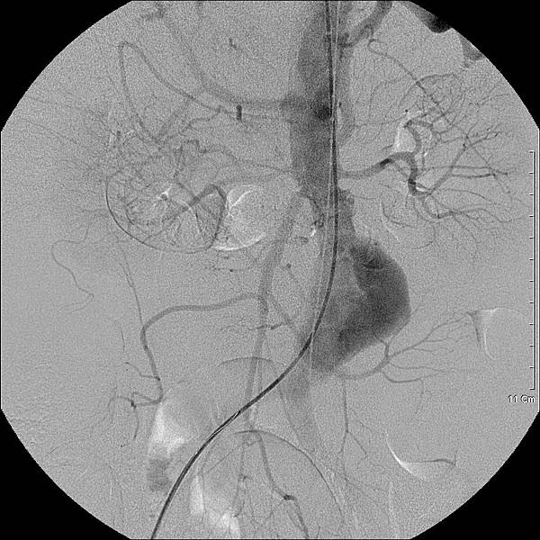 17 腹主動脈瘤支架手術.jpg