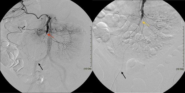 03 SMA embolism.jpg