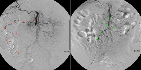 06 SMA embolism.jpg