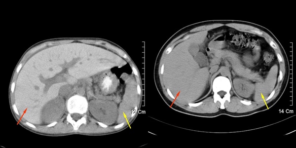 05 血色素沈著症 hemochromatosis-01.jpg