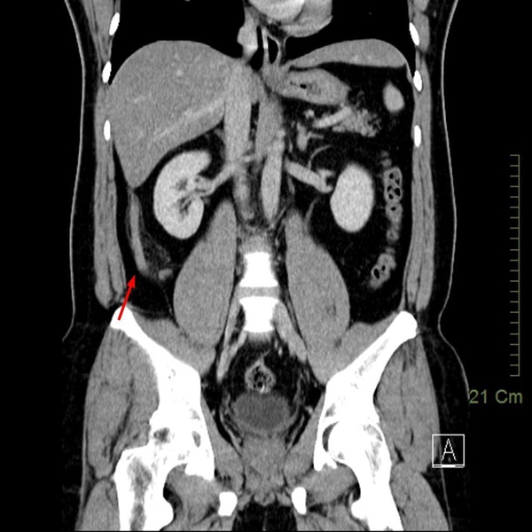 09 闌尾炎 appendicitis.jpg