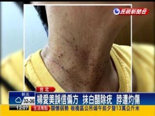 0531白醋疣.jpg 0531白醋疣.jpg