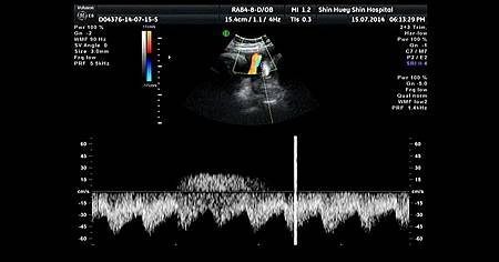 36w+6d 2很鬆的臍帶.jpg