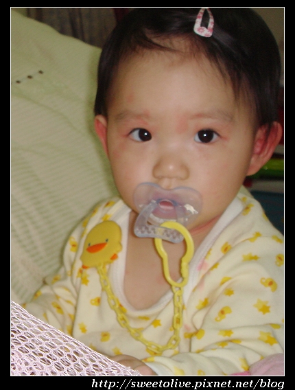 Doris 1Y16D 玫瑰疹 1.jpg Doris 1Y16D 玫瑰疹 1.jpg