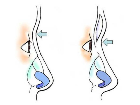 Glabella augmentation.jpg