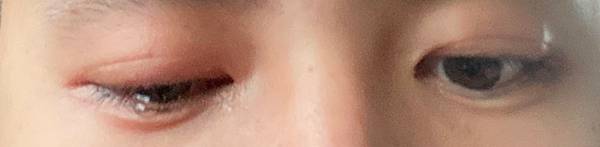 眼睛雷射_210526_0 眼睛雷射_210526_0