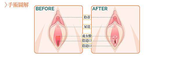 7處女膜修補