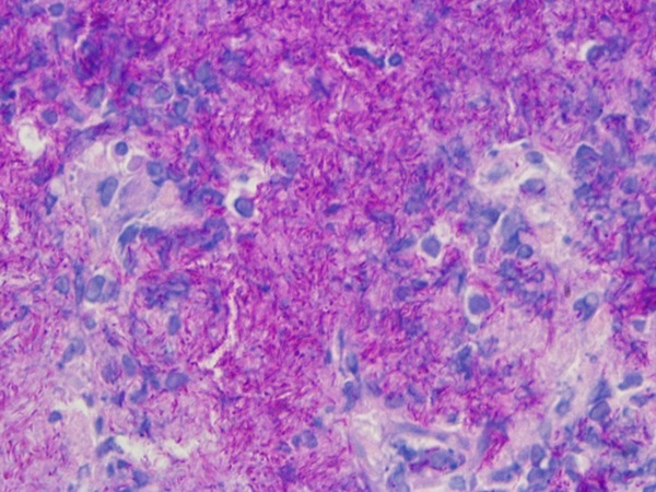 2 酸性快速細菌染色溶液 Acid-fast Staining Solution Servicebio貨號G1047-100ML.jpg 2 酸性快速細菌染色溶液 Acid-fast Staining Solution Servicebio貨號G1047-100ML.jpg