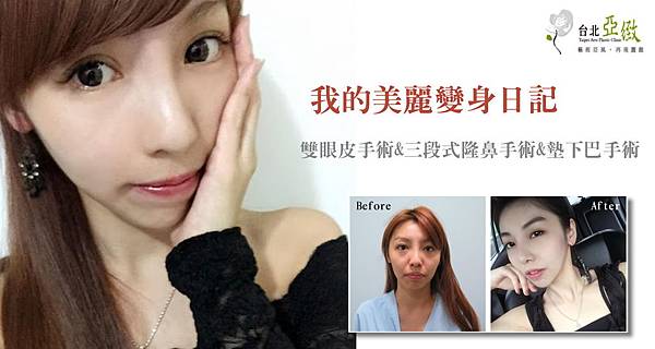 000三段式隆鼻手術價錢價格價位費用.jpg 000三段式隆鼻手術價錢價格價位費用.jpg