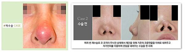 01全自體肋軟骨真皮隆鼻手術失敗後遺症風險副作用.jpg 01全自體肋軟骨真皮隆鼻手術失敗後遺症風險副作用.jpg