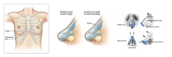 05二次隆鼻手術失敗重建失敗後遺症風險副作用.jpg 05二次隆鼻手術失敗重建失敗後遺症風險副作用.jpg
