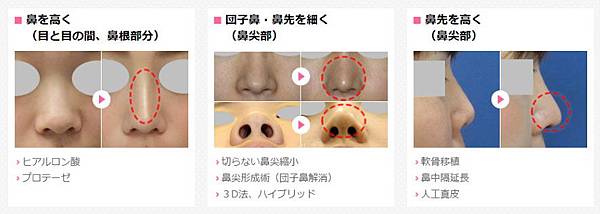 02隆鼻手術失敗二次隆鼻價格價位費用價錢又是如何計算?.jpg 02隆鼻手術失敗二次隆鼻價格價位費用價錢又是如何計算?.jpg