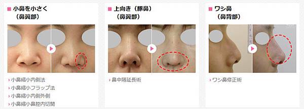 03二次隆鼻手術該選擇哪種材質來進行改善.jpg 03二次隆鼻手術該選擇哪種材質來進行改善.jpg