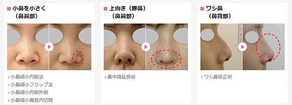 隆鼻手術失敗需做二次隆鼻該如何選擇 台灣台北台中台南高雄有那些隆鼻權威醫師推薦 該選擇哪種材質來進行改善 價格價位費用價錢又是如何計算 歪鼻朝天鼻爛鼻感染後遺症風險分析 台中整形醫美ptt討論區權威推薦
