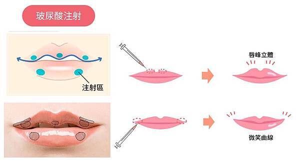 04縮唇修唇豐唇手術心得日記案例分享.jpg 04縮唇修唇豐唇手術心得日記案例分享.jpg