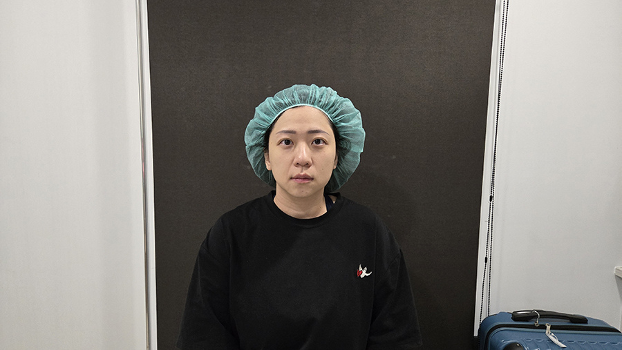 愛爾麗診所 全臉探索皮秒雷射(蜂巢)-術前 (1).jpg