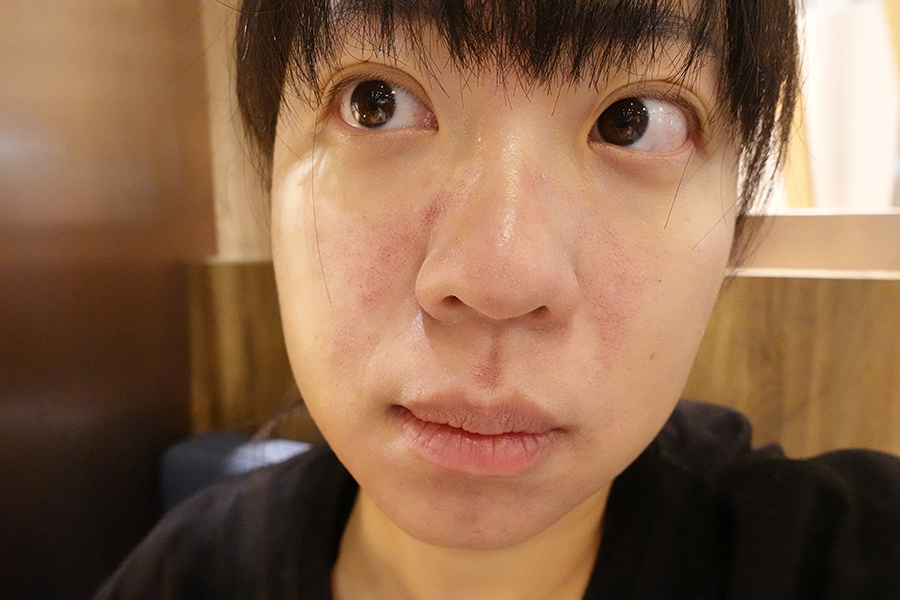 愛爾麗診所 全臉探索皮秒雷射(蜂巢)-Day1 (7).JPG