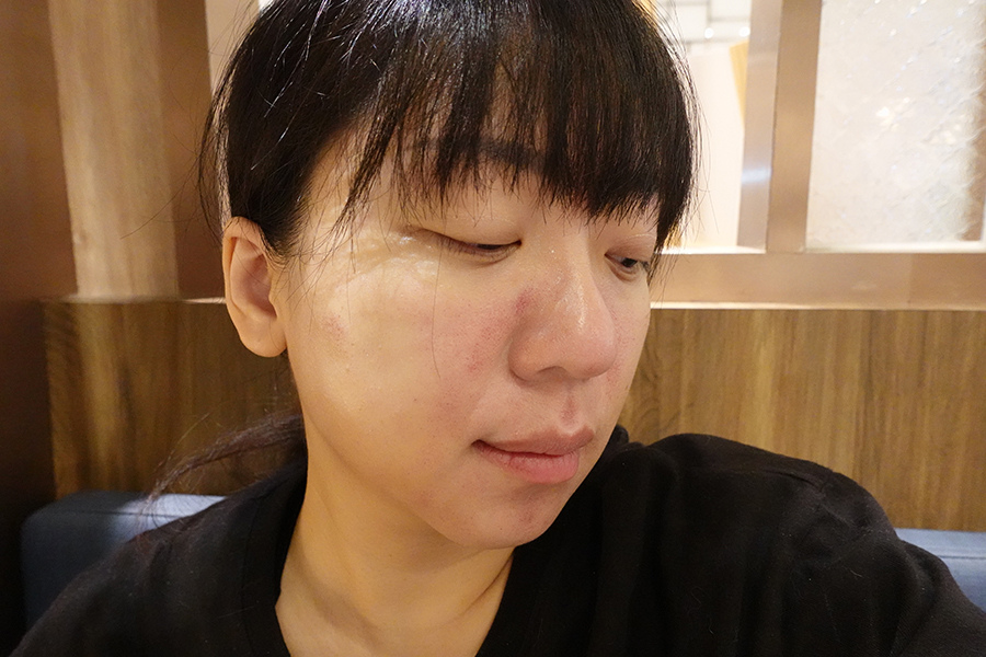 愛爾麗診所 全臉探索皮秒雷射(蜂巢)-Day1 (6).JPG