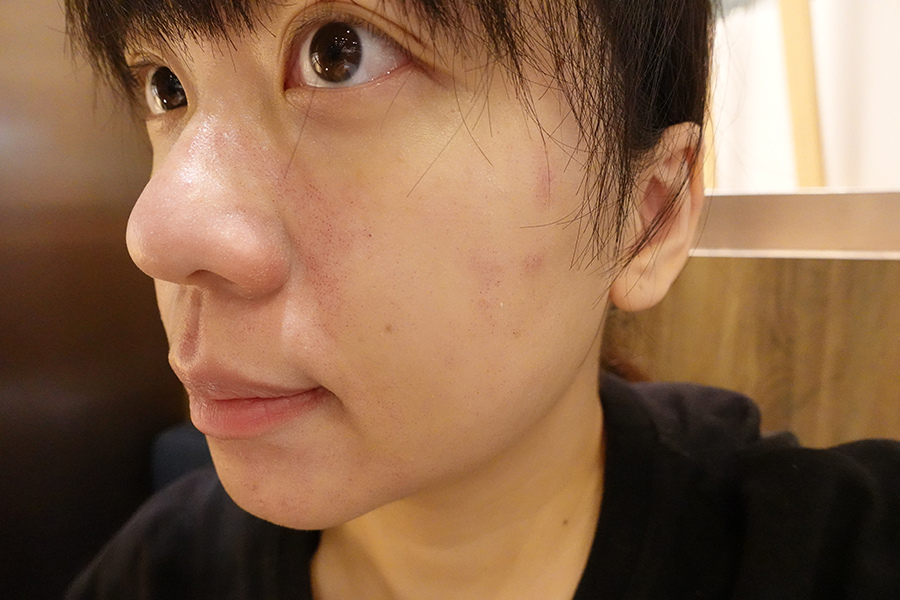 愛爾麗診所 全臉探索皮秒雷射(蜂巢)-Day1 (8).JPG