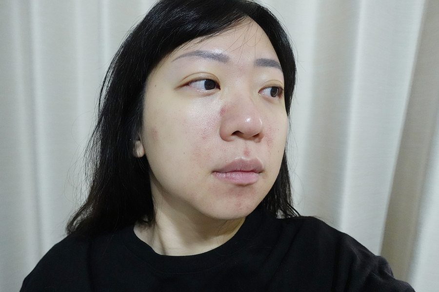 愛爾麗診所 全臉探索皮秒雷射(蜂巢)-Day2 (8).JPG