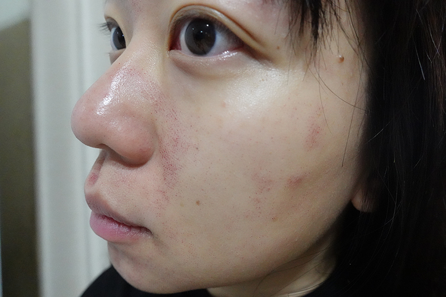 愛爾麗診所 全臉探索皮秒雷射(蜂巢)-Day2 (15).JPG