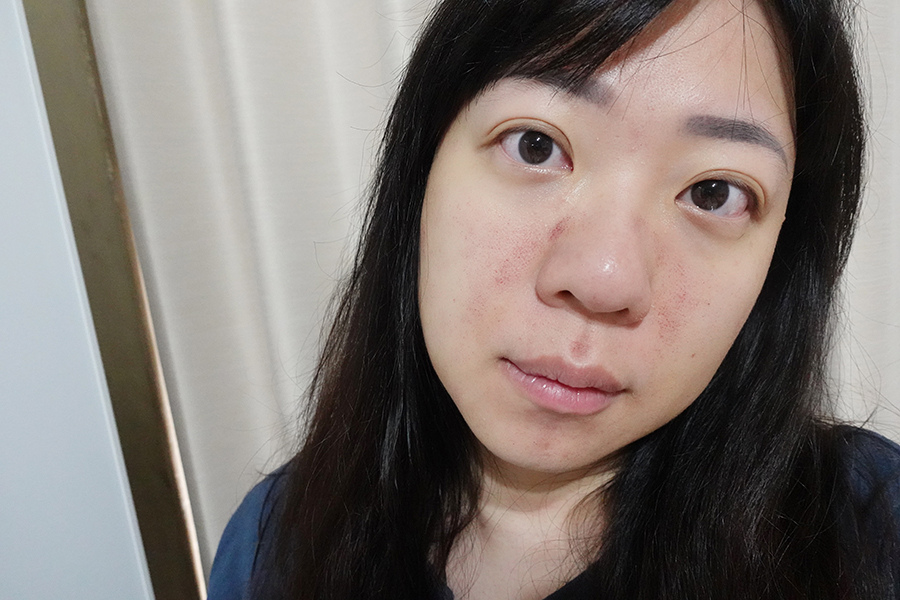 愛爾麗診所 全臉探索皮秒雷射(蜂巢)-Day3 (8).JPG