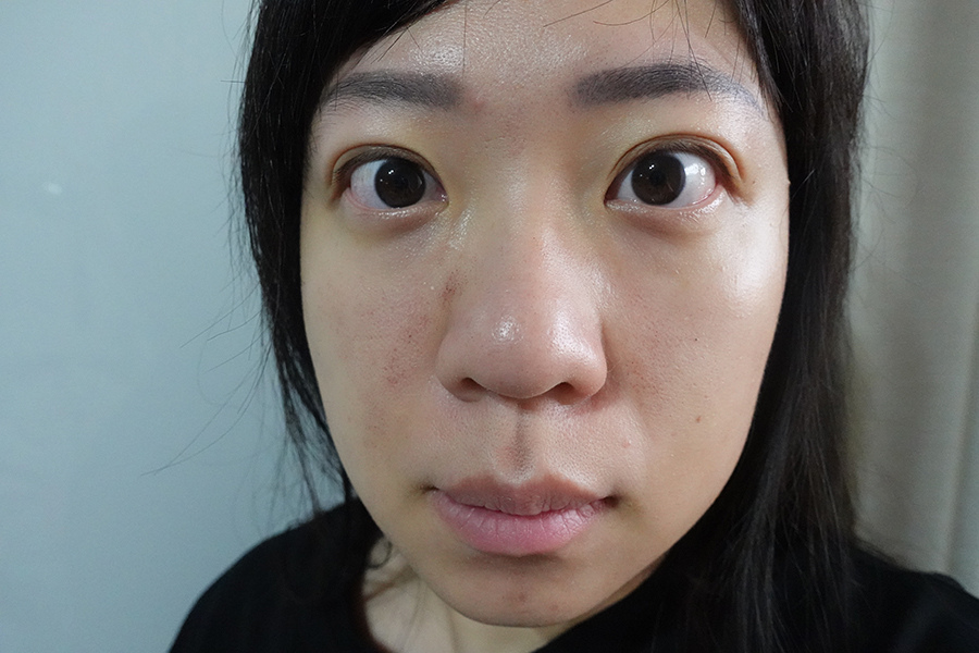 愛爾麗診所 全臉探索皮秒雷射(蜂巢)-Day5 (13).JPG