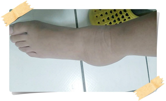 腳扭傷 (1).jpg 腳扭傷 (1).jpg