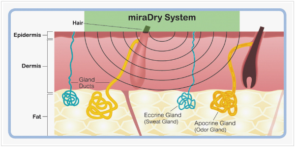 miraDry_04.jpg