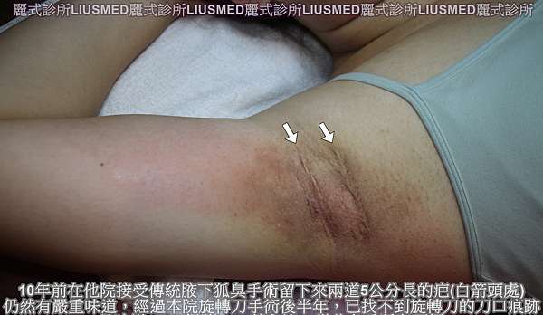 旋轉刀狐臭清除手術 常見問題及術後照顧 劉達儒dr Lius皮膚專科 痞客邦