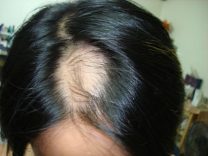 圓形禿alopecia Areata 劉達儒dr Lius皮膚專科 痞客邦