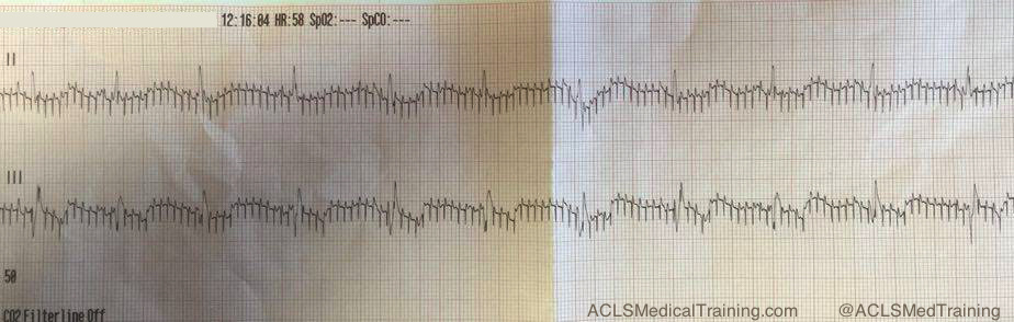 Neuromodulation_artifact.jpg