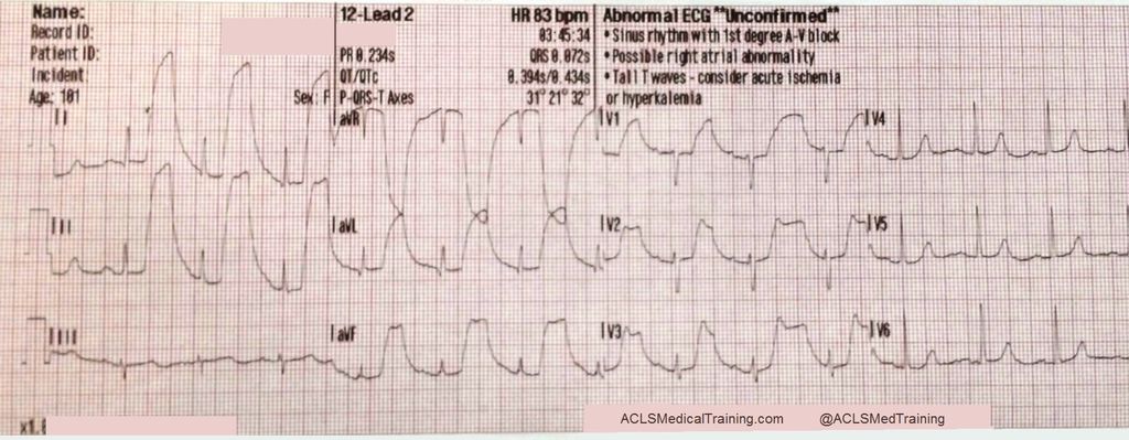 arterial_pulse_tapping_artifact.jpg