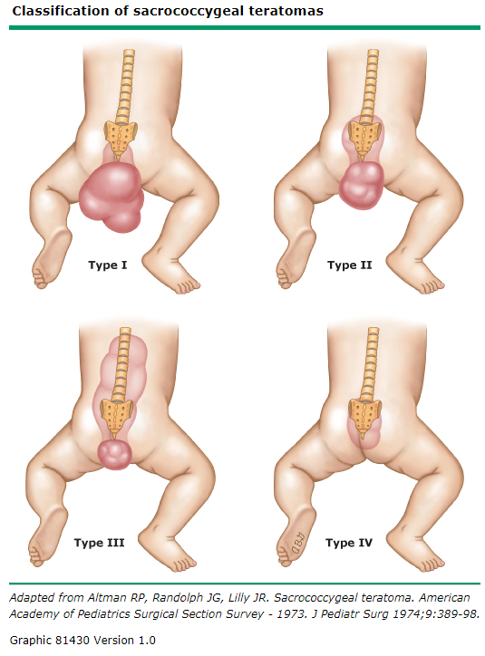 classification_of_sacrococcygeal_teratomas.PNG